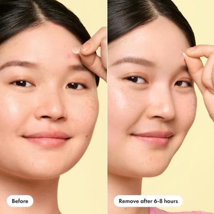 Imagem de Adesivos para acne para espinhas Hero Cosmetics Mighty Patch Mini (30 quilates)