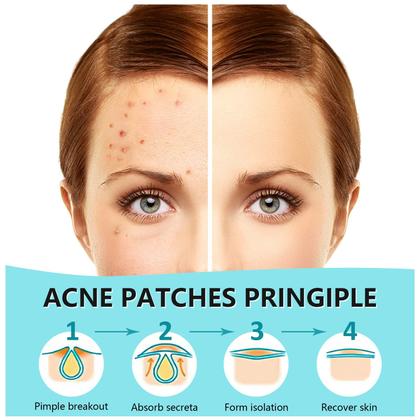 Imagem de Adesivos para espinhas PicCircuit, adesivo hidrocolóide para acne de 180 unidades