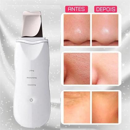 Imagem de Aparelho De Peeling Esfoliante Ultrassônico Limpeza Facial