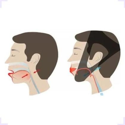 Imagem de Aparelho Para Ronco Bruxismo Queixo Nariz Apneia De Cabeça