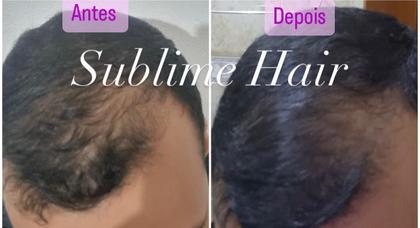 Imagem de Combo 2 Tônicos Sublime Hair Combate a Queda Preenche Falhas Acelera o Crescimento Para Homens e Mulheres
