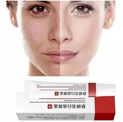 Imagem de Creme Clareador Melasma Manchas Sardas Ebug 20g