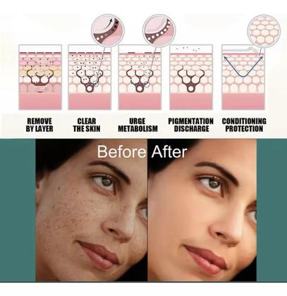 Imagem de Creme Para Tirar Remover Melasma Manchas Sardas Eelhoe.