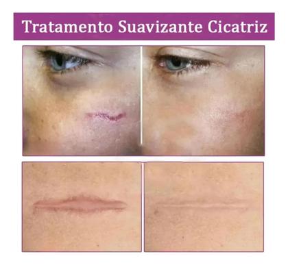 Imagem de Creme Poderoso Para Cicatriz Regeneração Da Pele 20g.