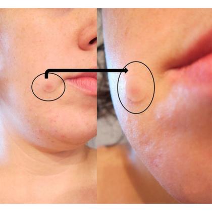 Imagem de Curativo Adesivo Hidrocoloide De Rosto Pele Aneica Acnes Anti Espinhas Seca Pele - Caixa C/24 Unidades