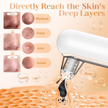 Imagem de Extrator de poros, removedor de cravos a vácuo Yccu com 5 cabeças de sucção