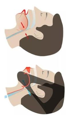 Imagem de Faixa Elástica Queixeira Anti Ronco Apneia Cabeça 3 Pontas