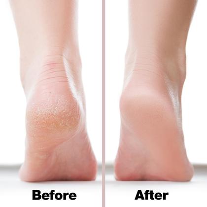 Imagem de Foot File Callus Remover Probelle de dupla face rosa níquel