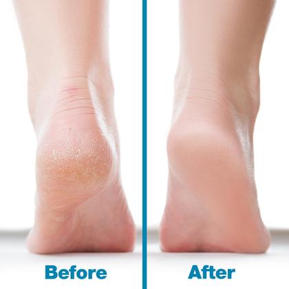Imagem de Foot File Callus Remover Probelle Dupla Face Azul Níquel
