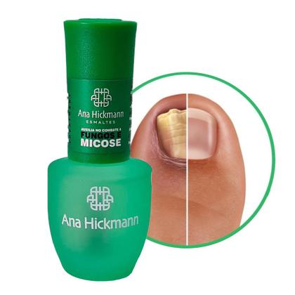 Imagem de Kit 3 Esmalte para Micose Anti Fungos Óleo de Melaleuca Antifungico Base Ana Hickmann 9ml