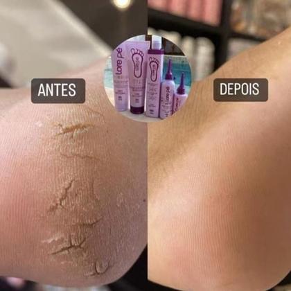 Imagem de Kit Lorepé: Saúde E Beleza Para Os Pés