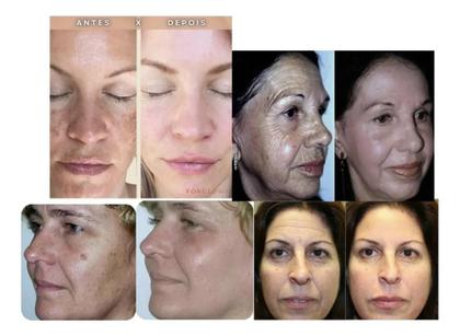 Imagem de Kit Retinol + Ácido Hialurônico 30ml para rejuvenescimento