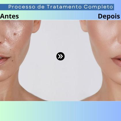 Imagem de Kit Skincare Anti Oleosidade Acne Para Peles Oleosas E Um Sérum Rosa Mosqueta Ultra Hidratante E Clareador De Manchas
