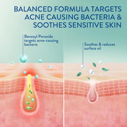 Imagem de Limpador Facial Cetaphil Gentle Clear Complexion com 2,6% de BPO - 125ml