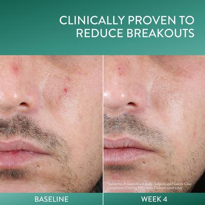 Imagem de Limpador Facial Cetaphil Gentle Clear Complexion com 2,6% de BPO - 125ml