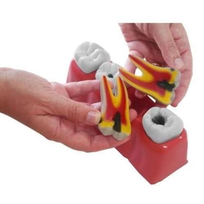 Imagem de Macro Modelo Anatômico Odontológico Evolução Da Cárie