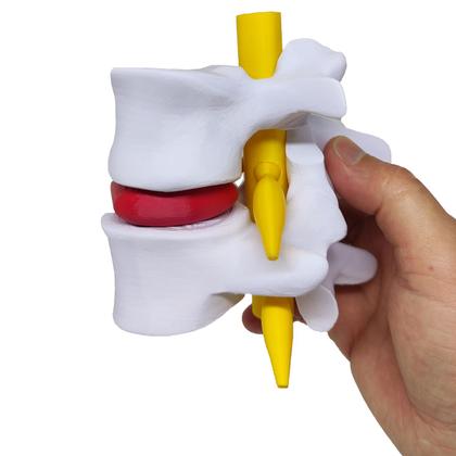 Imagem de Modelo Anatômico Hérnia Disco Lombar Coluna Vertebral Ortopedia 3D