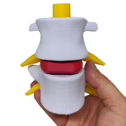 Imagem de Modelo Anatômico Hérnia Disco Lombar Coluna Vertebral