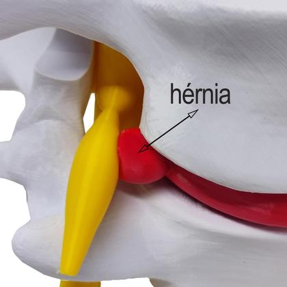 Imagem de Modelo Anatômico Hérnia Disco Lombar Coluna Vertebral