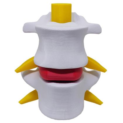 Imagem de Modelo Anatômico Hérnia Disco Lombar Coluna Vertebral