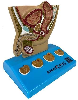 Imagem de Modelo De Próstata, Com Patologias