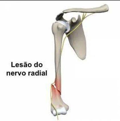 Imagem de Órtese Tutor Para Fratura de Úmero Sarmiento Todos Tamanhos - Artipe