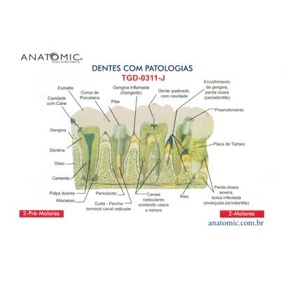 Imagem de Patologia Dentária e Placa Explicativa em 2 Partes, Anatomia