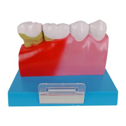 Imagem de Patologia Dentária e Placa Explicativa em 2 Partes, Anatomia
