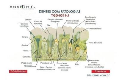 Imagem de Patologia Dentária E Placa Explicativa Em 2 Partes, Anatomia
