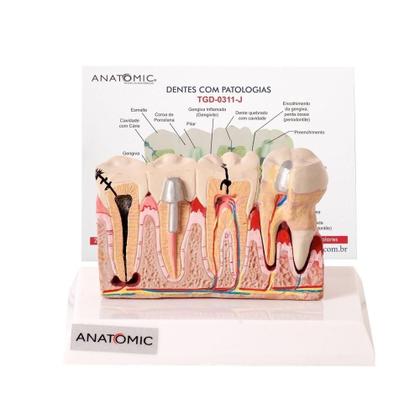 Imagem de Patologia Dentária E Placa Explicativa Em 2 Partes, Anatomia