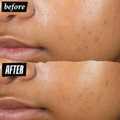 Imagem de Pimple Patch Kiehl's Truly Targeted Acne Clear-Clear 15 mL com ácido salicílico