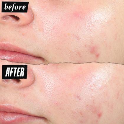 Imagem de Pimple Patch Kiehl's Truly Targeted Acne Clear-Clear 15 mL com ácido salicílico