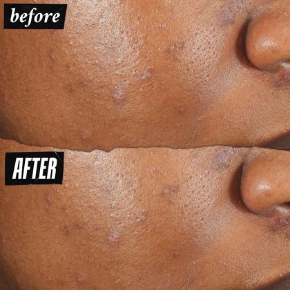 Imagem de Pimple Patch Kiehl's Truly Targeted Acne Clear-Clear 15 mL com ácido salicílico