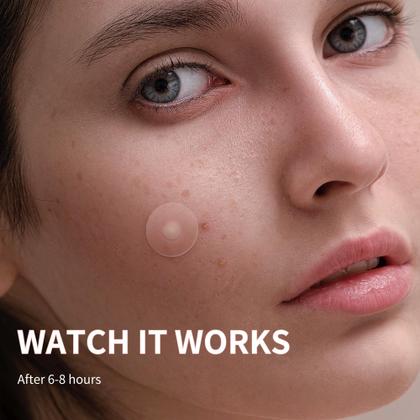 Imagem de Pimple Patches Daolyo 300, hidrocolóide com ácido salicílico
