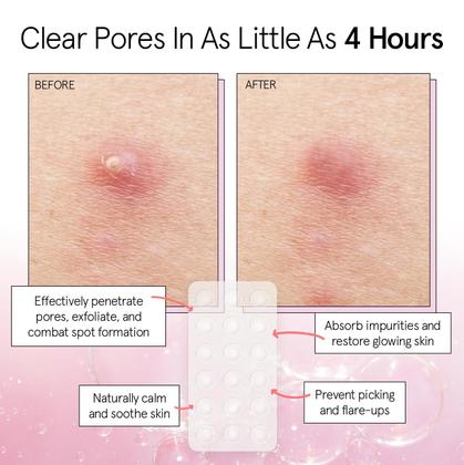 Imagem de Pimple Patches Grace & Stella, vencedora do prêmio FSA HSA 72 Count