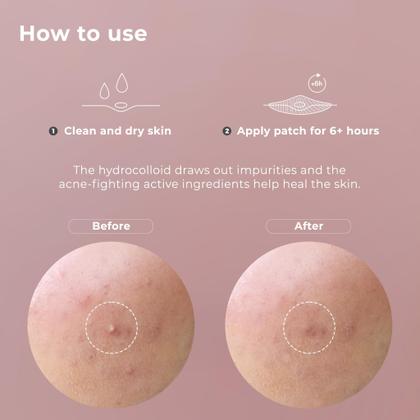 Imagem de Pimple Patches, hidrocolóide coreano OMMA, 10 mm (72 unidades)