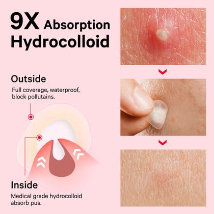 Imagem de Pimple Patches Hidrocolóide invisível Sosky com ácido salicílico