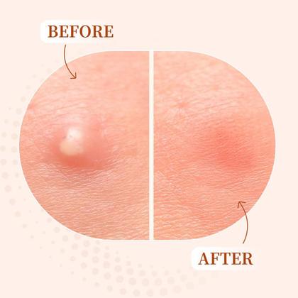 Imagem de Pimple Patches SOVEE 96 unidades de hidrocolóide com ácido salicílico