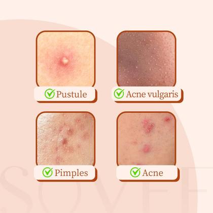 Imagem de Pimple Patches SOVEE 96 unidades de hidrocolóide com ácido salicílico