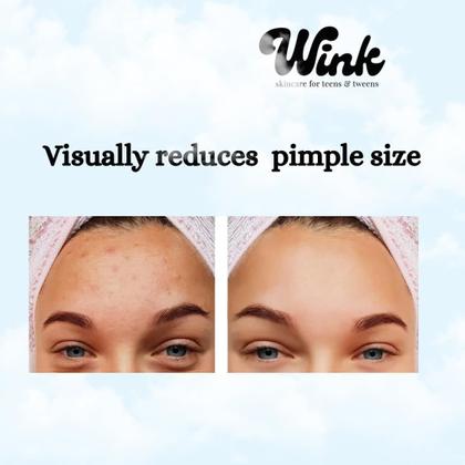 Imagem de Pimple Patches WINK Skincare, hidrocolóide de 120 unidades para adolescentes