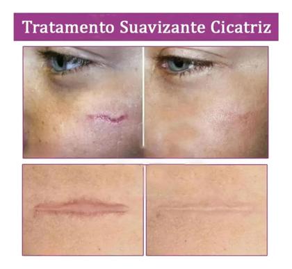 Imagem de Pomada Creme Para Tratamento Cicatriz DermaTriz 20g.