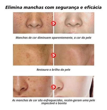 Imagem de Pomada Reparação Facial Clareamento Sardas Manchas Melasma eb