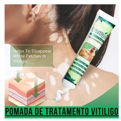 Imagem de Pomada Tratamento Vitiligo Sumifun