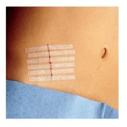 Imagem de Ponto Falso C/2 Envelope 6 Tiras Cada Colocar Sobre Cortes E Feridas