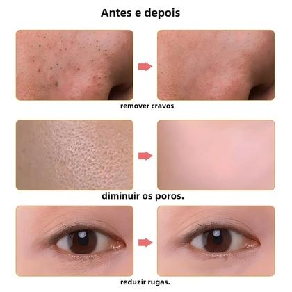 Imagem de Purificador Facial Ultrassônico, Limpeza Profunda Dos Poros, Peeling Da Pele, Remoção De Acne,