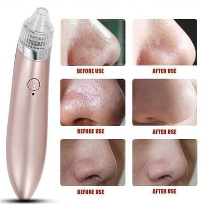 Imagem de  Removedor Cravos Extrator Facial A Vácuo Sucção Xn8030