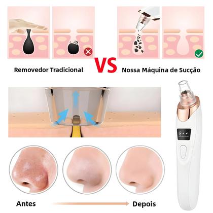 Imagem de Removedor De Cravos a Vácuo Para O Rosto Com 3 Modos De Sucção, Máquina De Limpeza De Pele,