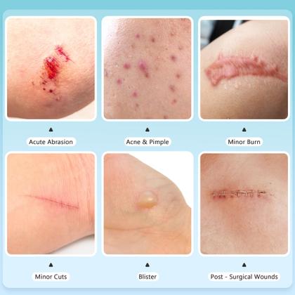 Imagem de Rolo de hidrocolóide para tratamento de feridas Ruzmmo Medical Grade 5m