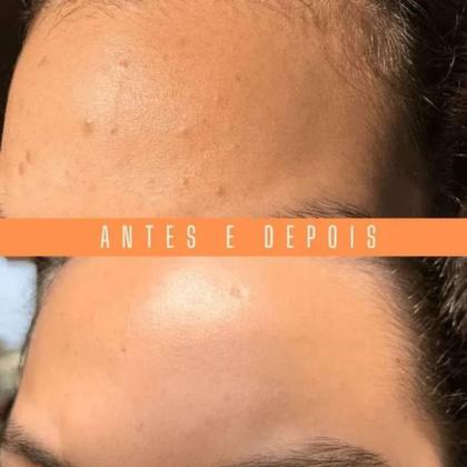 Imagem de SABONETE FACIAL ANTI ACNE ACNIX 240ml NATUFLORES 2un