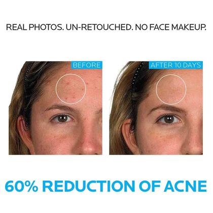 Imagem de Sistema de tratamento da acne La Roche-Posay Effaclar 3 etapas e 2 meses